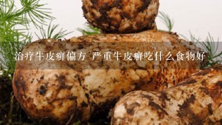 治疗牛皮癣偏方 严重牛皮癣吃什么食物好